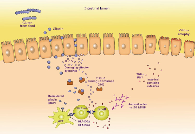 Autoimmune response coeliac disease - October 2019.