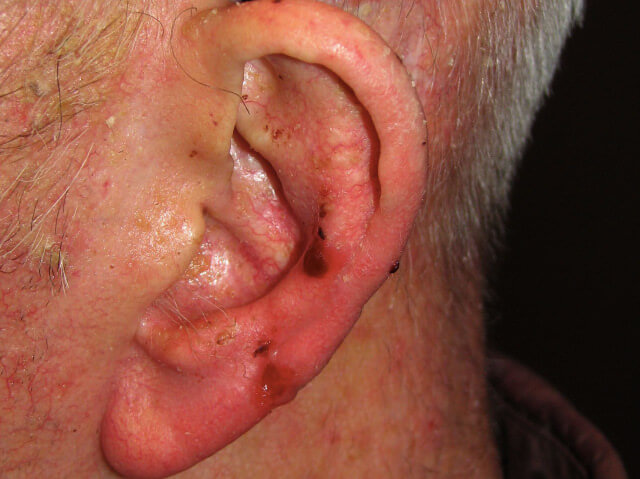 This image depicts clinical features basal cell carcinoma (BCC). Professional medical imaging for clinical reference and educational purposes. [umbracoNodeId=12331]