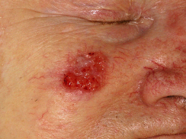 This image depicts clinical features of squamous cell carcinoma (SCC). Professional reference image for clinical and educational purposes. [umbracoNodeId=12329]