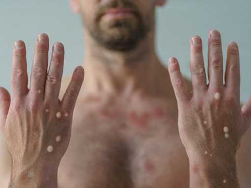 Figure 1. Raised vesicles on the hands of a male with mpox - Oct 2022