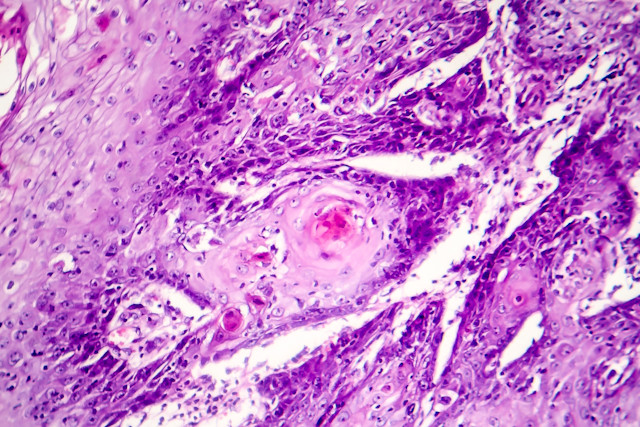 This image depicts histology of squamous cell carcinoma (SCC). Professional medical imaging for clinical reference and educational purposes. [umbracoNodeId=12918]