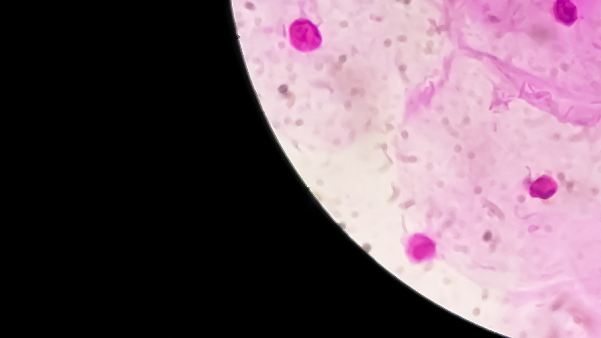 Sept 2025 - Bacterial Vaginosis