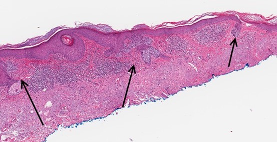 This image depicts superficial and multifocal basal cell carcinoma. Professional medical imaging for clinical reference and educational purposes. [umbracoNodeId=18661]