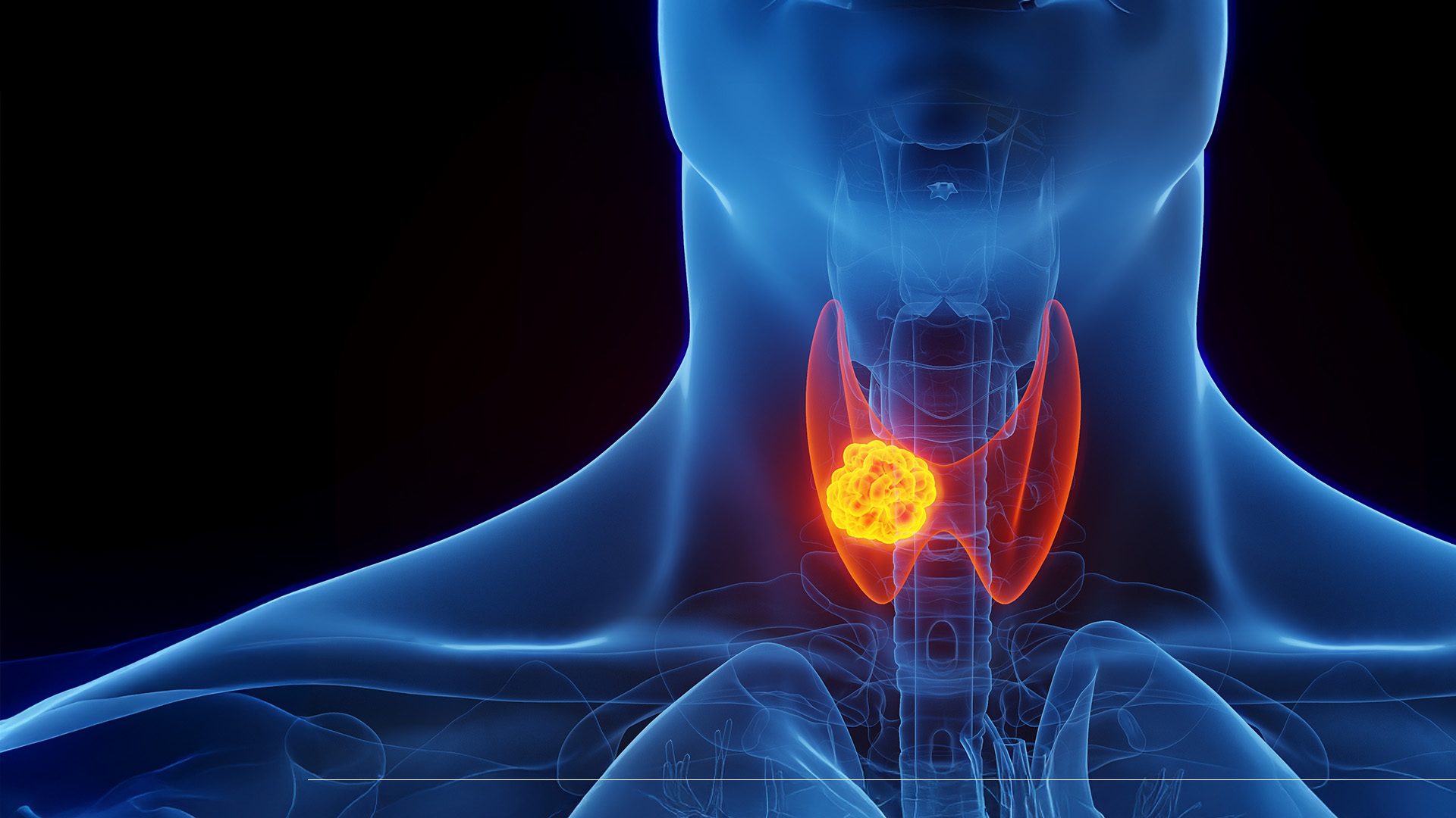 Thyroid cancer