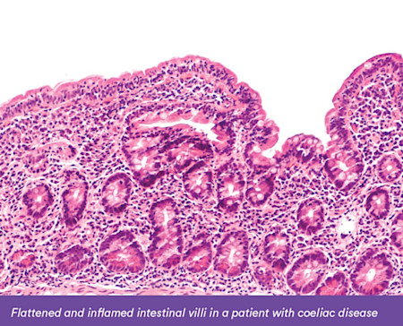 unhealthy villi - coeliac disease - October 2019.